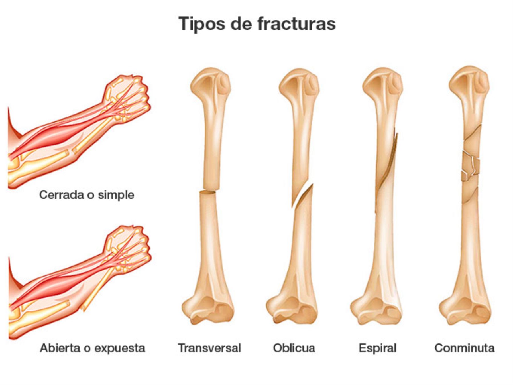 Fracturas